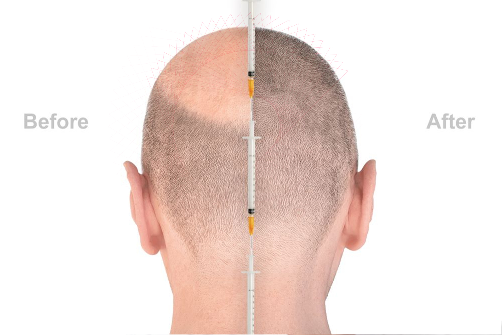 Hair transplantation surgery زراعة الشعر Hair Transplant Hair Transplant